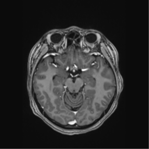 Cerebral cavernous venous malformations (Radiopaedia 48117-52946 Axial T1 C+ 21).png
