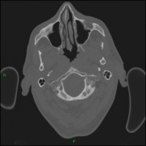 Cerebral contusions (Radiopaedia 33868-35039 Axial bone window 12).jpg