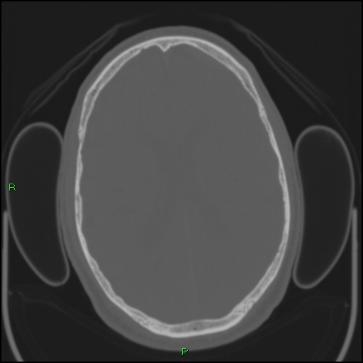 Cerebral contusions (Radiopaedia 33868-35039 Axial bone window 127).jpg