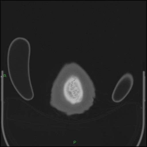 File:Cerebral contusions (Radiopaedia 33868-35039 Axial bone window 225).jpg