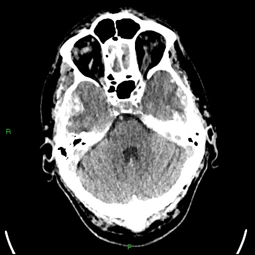 Cerebral contusions (Radiopaedia 33868-35039 Axial non-contrast 58).jpg