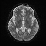 Cerebral embolic infarcts (embolic shower) (Radiopaedia 72391-82921 Axial DWI 14).jpg
