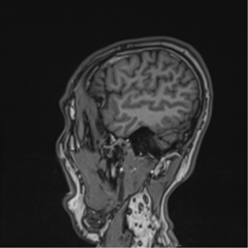 Cerebral fat embolism (Radiopaedia 57697-64639 Sagittal T1 14).png