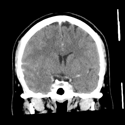 Cerebral hemorrhage secondary to arteriovenous malformation (Radiopaedia 33497-34561 C 29).png