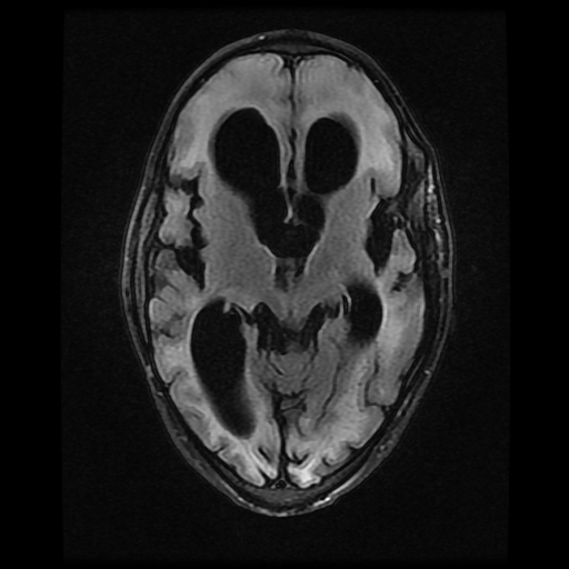 File:Cerebral manifestations of mucopolysaccharidosis type I (Radiopaedia 59171-66487 Axial FLAIR 9).jpg