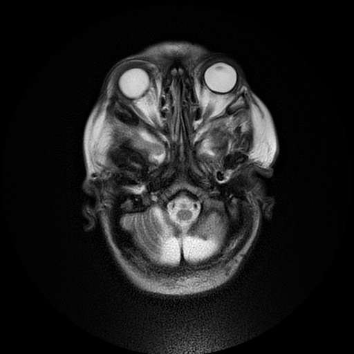 File:Cerebral manifestations of mucopolysaccharidosis type I (Radiopaedia 59171-66487 Axial T2 3).jpg