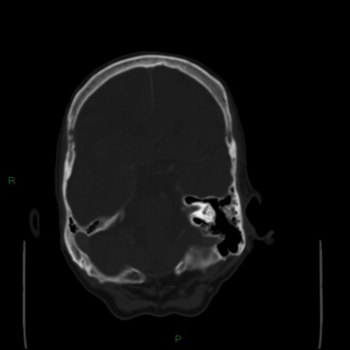 Cerebral metastases - breast primary (Radiopaedia 77653-89857 Axial bone window 38).jpg