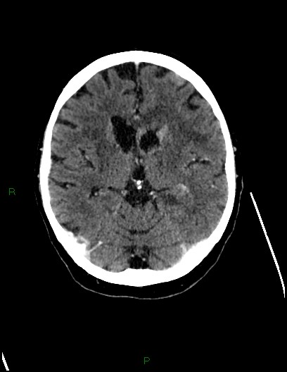 Cerebral metastases - ependymal and parenchymal (Radiopaedia 79877-93131 Axial C+ delayed 41).jpg