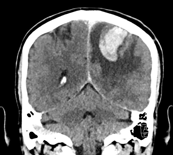 Cerebral metastases - testicular choriocarcinoma (Radiopaedia 84486-99855 D 43).jpg