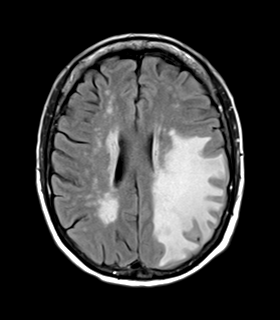 File:Cerebral metastasis (Radiopaedia 46744-51248 Axial FLAIR 18).png