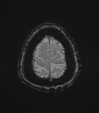 Cerebral metastasis to basal ganglia (Radiopaedia 81568-95413 Axial SWI 81).png