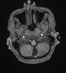 File:Cerebral toxoplasmosis (Radiopaedia 43956-47461 Axial T1 6).jpg