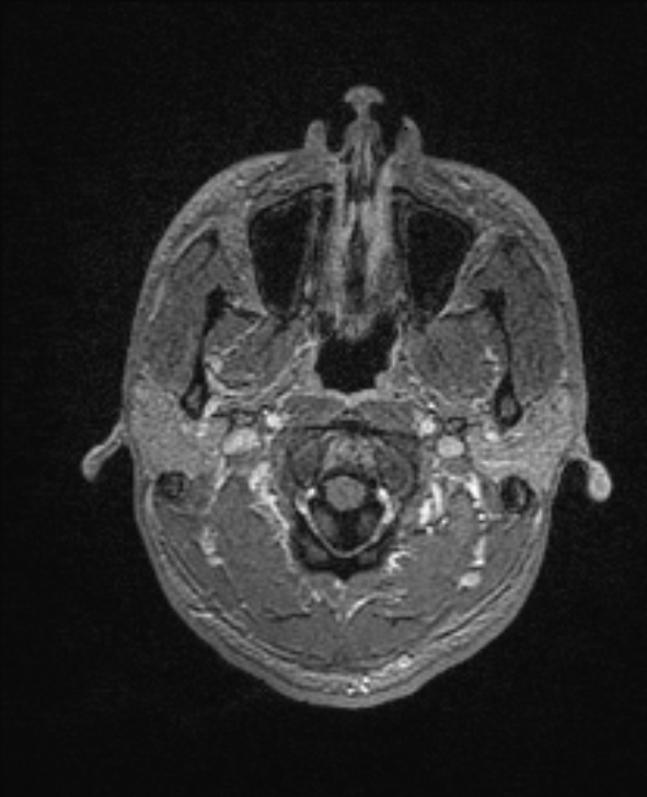 Cerebral toxoplasmosis (Radiopaedia 85779-101597 Axial T1 C+ 12).jpg
