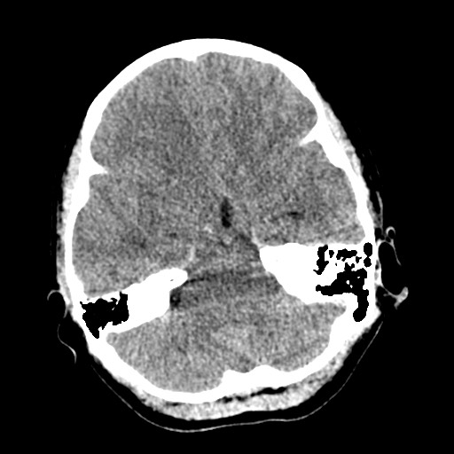 Cerebral tuberculosis with dural sinus invasion (Radiopaedia 60353-68018 Axial non-contrast 15).jpg
