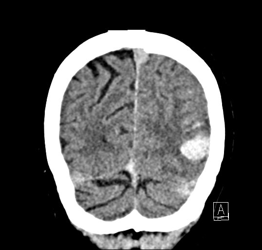 Cerebral venous infarction with hemorrhage (Radiopaedia 65343-74381 Coronal non-contrast 48).jpg