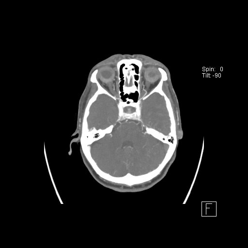 File:Cerebral venous infarction with hemorrhage (Radiopaedia 65343-74396 A 31).jpg