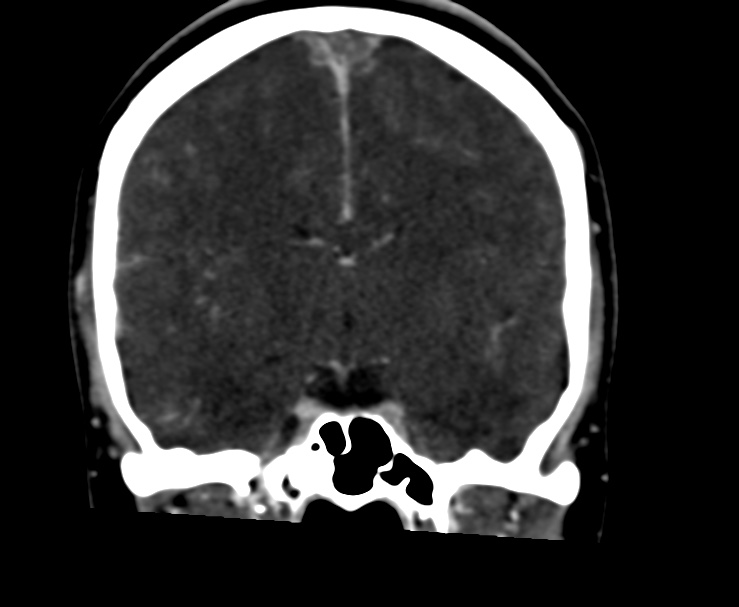 Cerebral venous sinus thrombosis (Radiopaedia 59224-66646 Coronal C+ delayed 37).jpg