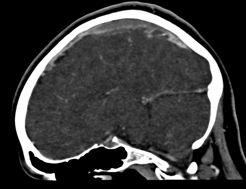 Cerebral venous sinus thrombosis (Radiopaedia 59224-66646 Sagittal C+ delayed 19).jpg
