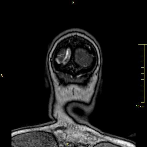 Cerebral venous thrombosis (Radiopaedia 23288-23351 MRV 175).JPG