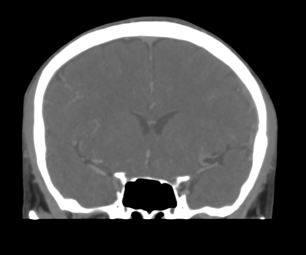 Cerebral venous thrombosis (Radiopaedia 38392-40467 Coronal CTA-Venogram 24).png