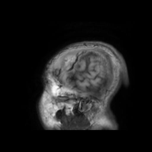 File:Cerebral venous thrombosis with secondary intracranial hypertension (Radiopaedia 89842-106957 Sagittal T1 3).jpg