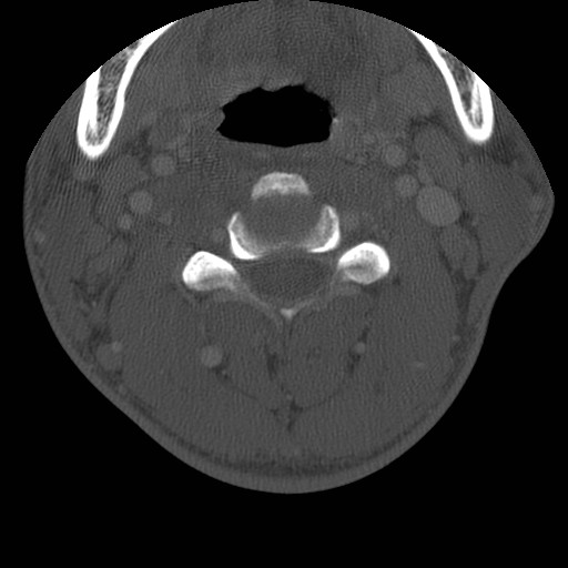 Cervical Pott disease (Radiopaedia 20374-20286 Axial bone window 62).jpg