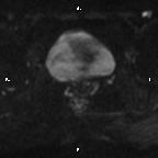 File:Cervical adenocarcinoma (Radiopaedia 65011-73985 Axial DWI 35).jpg