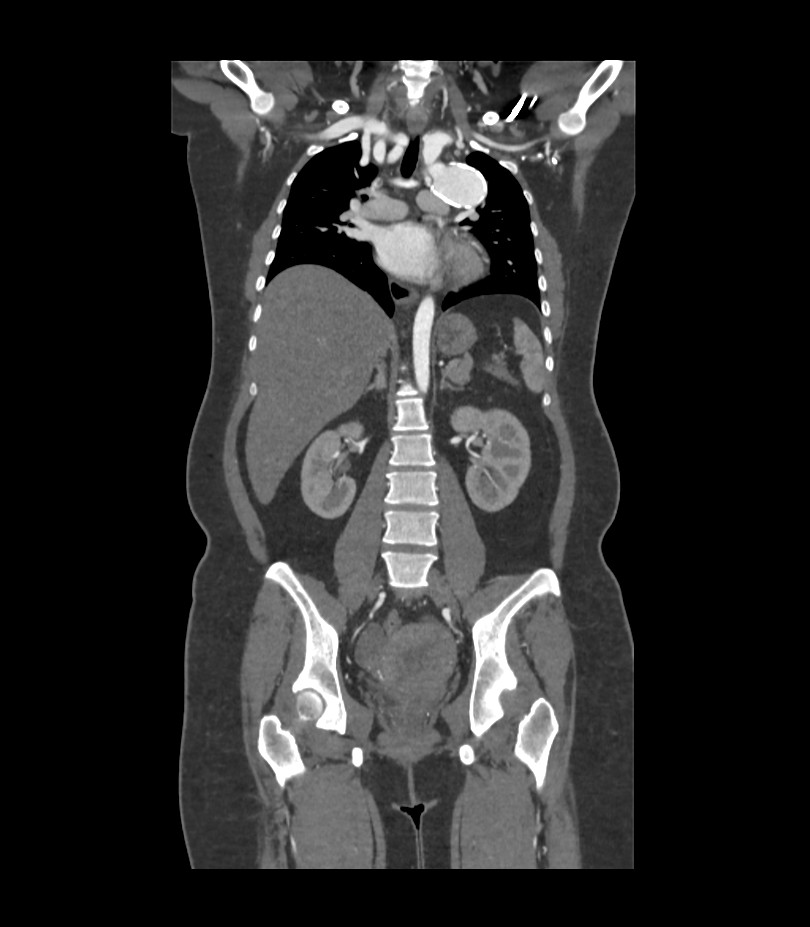Cervical aortic arch with coarctation and aneurysms (Radiopaedia 44035-47552 C 21).jpg