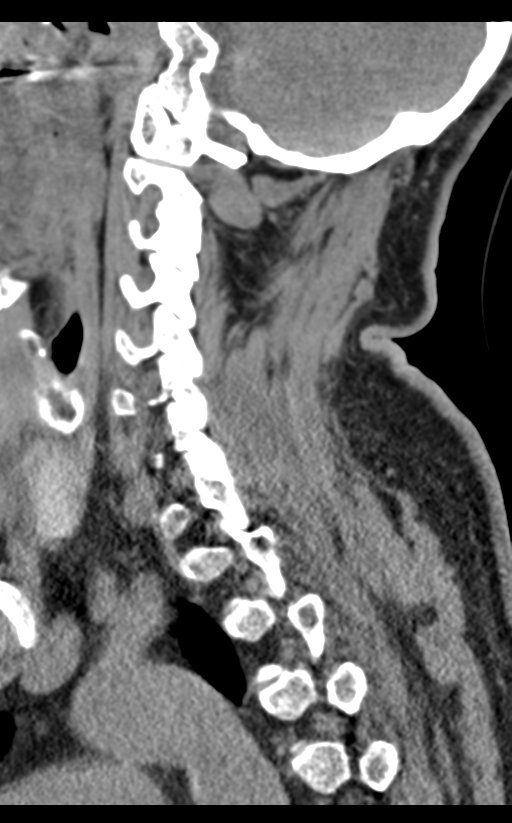 Cervical canal stenosis - OPLL and osteophytes (Radiopaedia 47329-51910 B 27).png