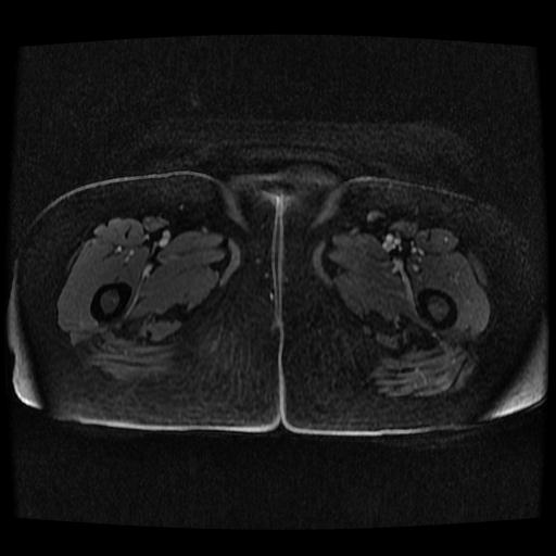 Cervical carcinoma (Radiopaedia 70924-81132 Axial T1 C+ fat sat 184).jpg