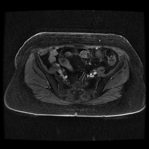 Cervical carcinoma (Radiopaedia 70924-81132 Axial T1 C+ fat sat 68).jpg