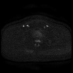 Cervical carcinoma (Radiopaedia 85405-101028 Axial DWI 65).jpg