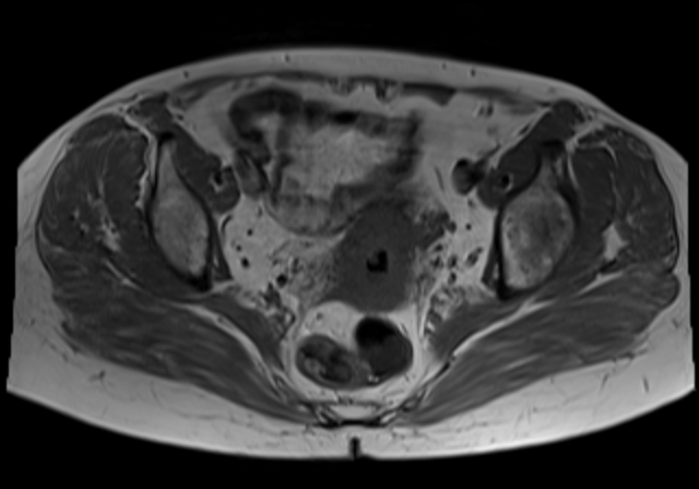 File:Cervical carcinoma (Radiopaedia 88312-104943 Axial T1 12).jpg