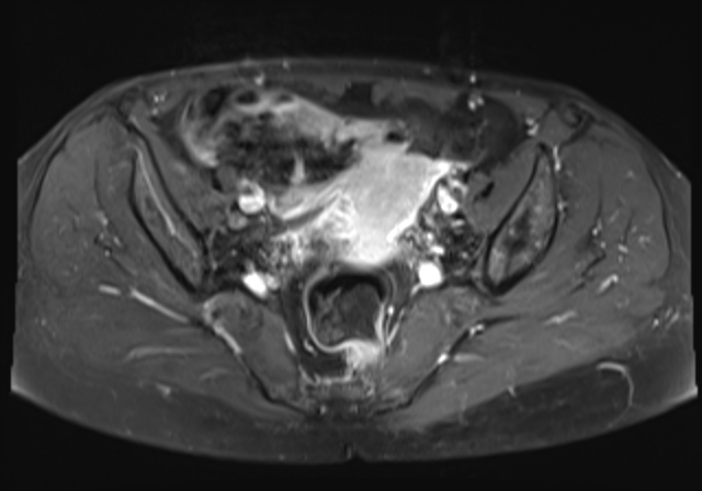 File:Cervical carcinoma (Radiopaedia 88312-104943 Axial T1 C+ fat sat 10).jpg