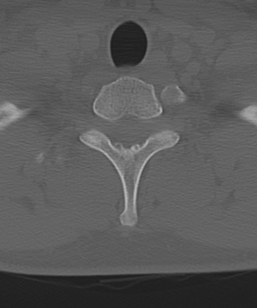 Cervical intercalary bone (Radiopaedia 35211-36748 Axial bone window 59).png