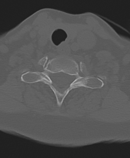 Cervical spine ACDF loosening (Radiopaedia 48998-54071 Axial bone window 47).png