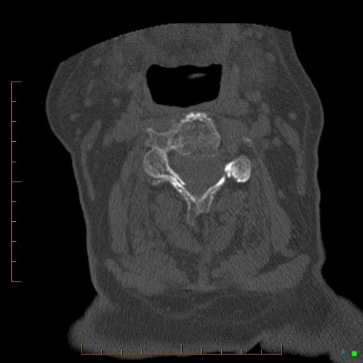 Cervical spine fracture - ankylosing spondylitis (Radiopaedia 76835-88706 Axial bone window 91).jpg