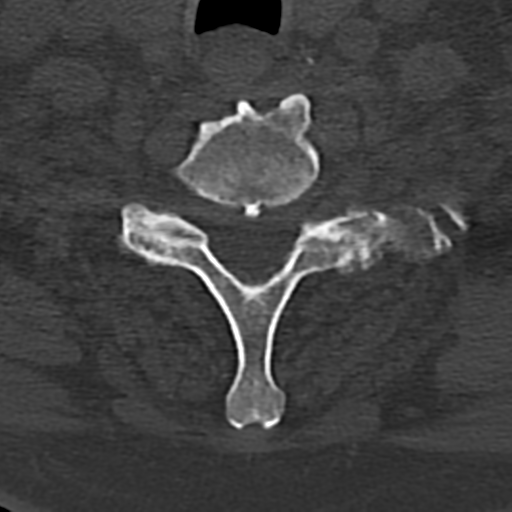 Cervical spine fracture - chalk stick (Radiopaedia 39116-41323 Axial bone window 75).png