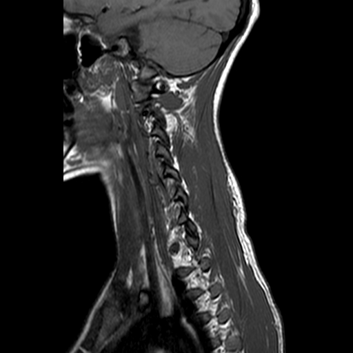 File:Cervical spine posterior ligamentous complex rupture (Radiopaedia 63486-72103 Sagittal T1 1).jpg