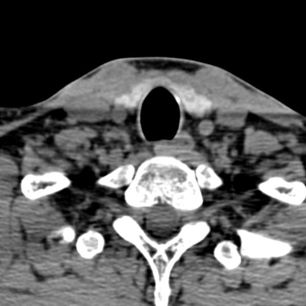 Cervical spondylodiscitis (Radiopaedia 28057-29489 Axial non-contrast 69).jpg