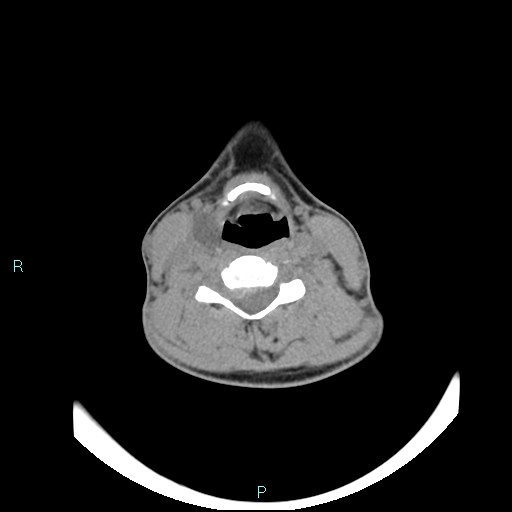 File:Cervical thymic cyst (Radiopaedia 88632-105335 Axial non-contrast 58).jpg