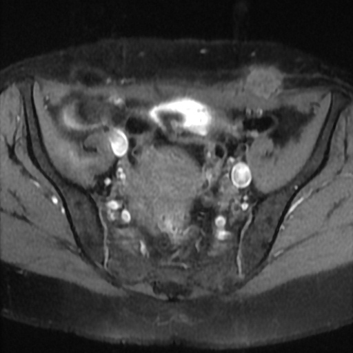 File:Cesarian section scar endometriosis (Radiopaedia 66520-75799 Axial T1 fat sat 8).jpg
