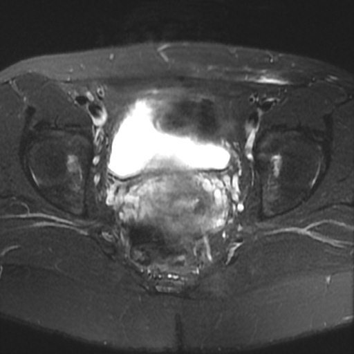 File:Cesarian section scar endometriosis (Radiopaedia 66520-75799 Axial T2 fat sat 16).jpg