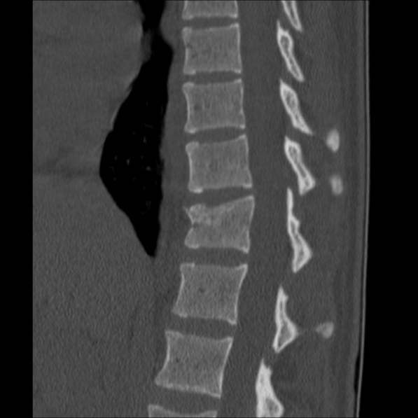 Chance fracture (Radiopaedia 36521-38081 Sagittal bone window 28).jpg