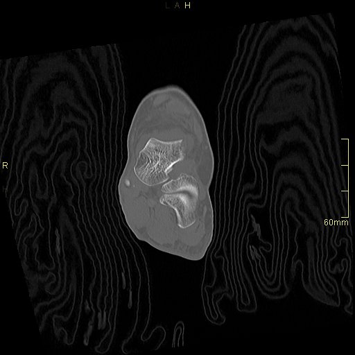 Chaput tubercle fracture (Radiopaedia 80319-93956 Coronal non-contrast 30).jpg