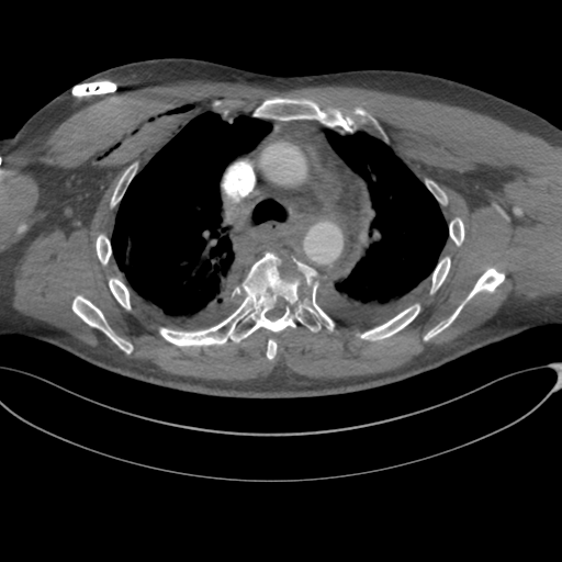 File:Chest multitrauma - aortic injury (Radiopaedia 34708-36147 A 105).png