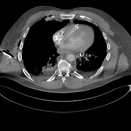 File:Chest multitrauma - aortic injury (Radiopaedia 34708-36147 A 188).png