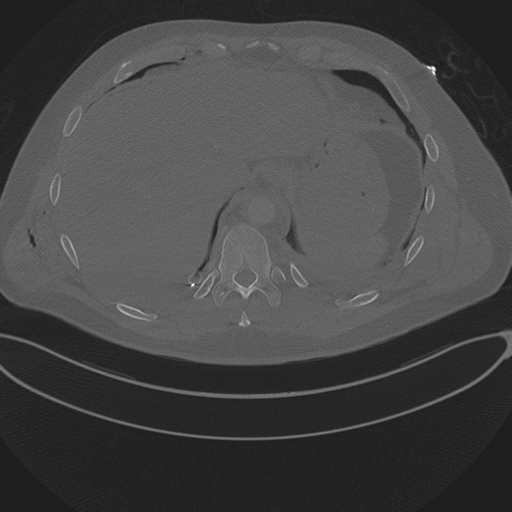 File:Chest multitrauma - aortic injury (Radiopaedia 34708-36147 Axial bone window 255).png
