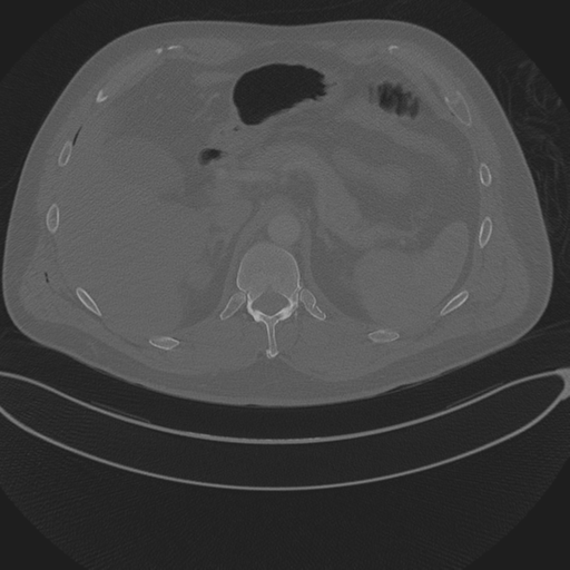 Chest multitrauma - aortic injury (Radiopaedia 34708-36147 Axial bone window 297).png