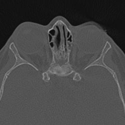 Choanal atresia (Radiopaedia 88525-105975 Axial bone window 91).jpg
